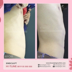 EMSCULPT-13