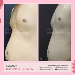 EMSCULPT-14