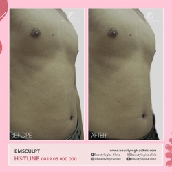 EMSCULPT-15