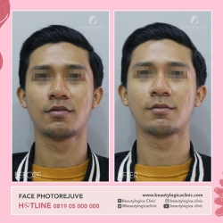 FACE-PHOTOREJUVE-01