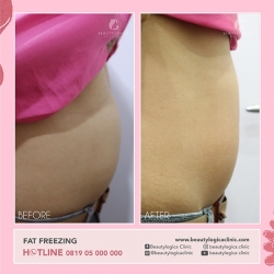 FAT-FREEZING-04