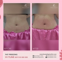 FAT-FREEZING-05