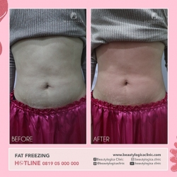 FAT-FREEZING-07