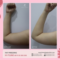 FAT-FREEZING-09