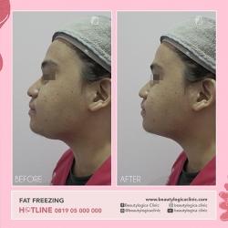 FAT-FREEZING-13