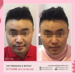 FAT-FREEZING-BOTOX-01