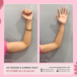 FAT-FREEZING-SLIMMING-INJECT-01