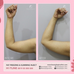 FAT-FREEZING-SLIMMING-INJECT-02