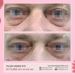 FILLER-UNDER-EYE-01