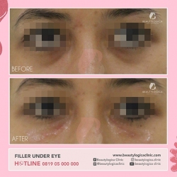 FILLER-UNDER-EYE-02