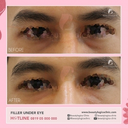 FILLER-UNDER-EYE-03