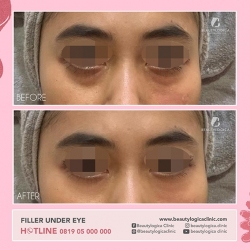 FILLER-UNDER-EYE-04