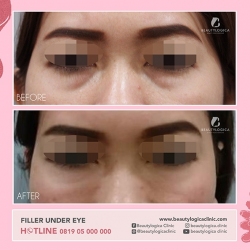FILLER-UNDER-EYE-05