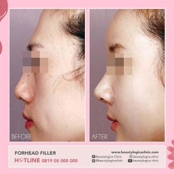 FORHEAD-FILLER-01