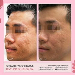 GROWTH-FACTOR-REJUVE-02