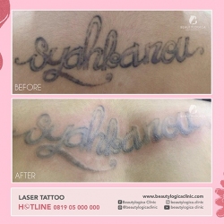 LASER-TATTOO-1