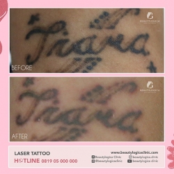 LASER-TATTOO-2