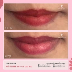 LIP-FILLER-01