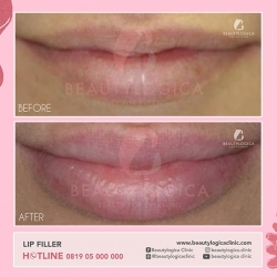LIP-FILLER-02
