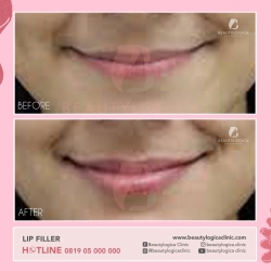 LIP-FILLER-03