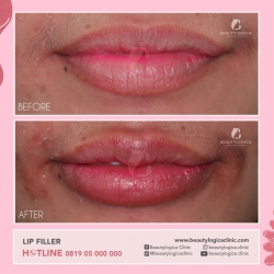 LIP-FILLER-04