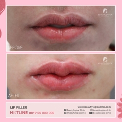LIP-FILLER-05