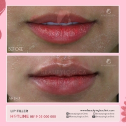 LIP-FILLER-06