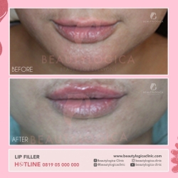 LIP-FILLER-07