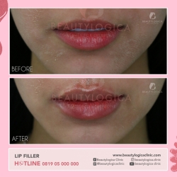 LIP-FILLER-08