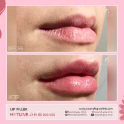 LIP-FILLER-09