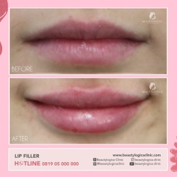 LIP-FILLER-10