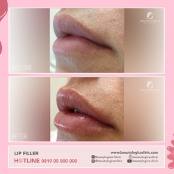 LIP-FILLER-11