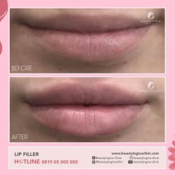 LIP-FILLER-12