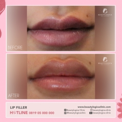 LIP-FILLER-13