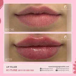 LIP-FILLER-14