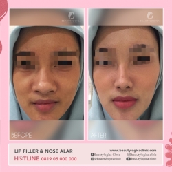 LIP-FILLER-DAN-NOSE-ALAR