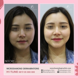MICRODIAMOND-DERMABRATION-03