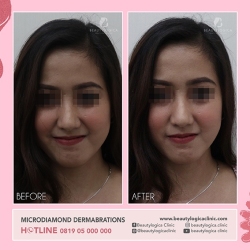MICRODIAMOND-DERMABRATION-04