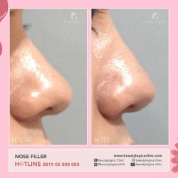 NOSE-FILLER-01