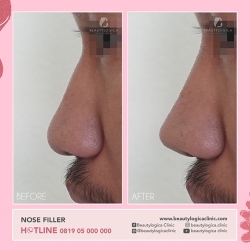 NOSE-FILLER-02