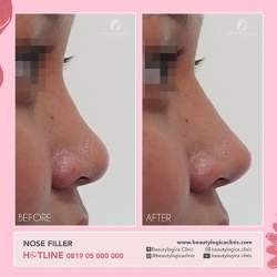 NOSE-FILLER-03