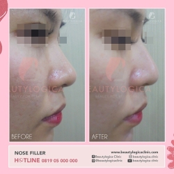NOSE-FILLER-04