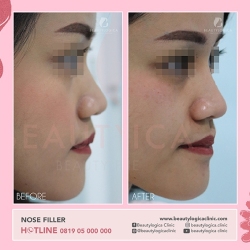 NOSE-FILLER-08