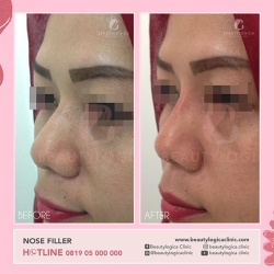 NOSE-FILLER-09