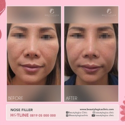 NOSE-THREADLIFT-01
