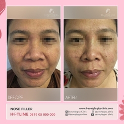 NOSE-THREADLIFT-02