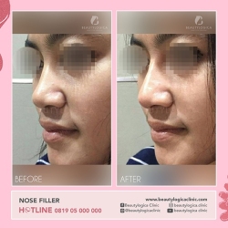 NOSE-THREADLIFT-03