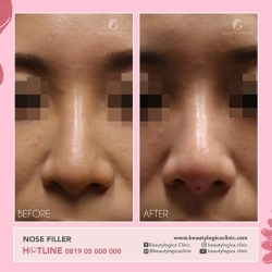 NOSE-THREADLIFT-05