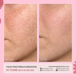 PHOTOREJUVENATION-03