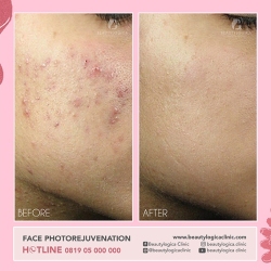 PHOTOREJUVENATION-04